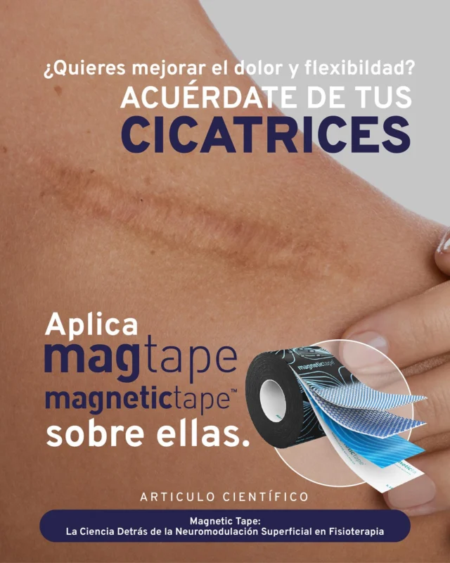 🧲 ¿Quieres mejorar el dolor y la flexibilidad?
¡ACUÉRDATE DE TUS CICATRICES!
⠀
Las cicatrices pueden alterar el equilibrio neuromuscular.
⠀
✨ Aplica Magnetic Tape directamente sobre ellas y siente la diferencia.
⠀
🔬 Respaldo científico disponible:
📄 “Magnetic Tape: La ciencia detrás de la neuromodulación superficial en fisioterapia.” 

https://mag-tape.com/magnetic-tape-la-ciencia-detras-de-la-neuromodulacion-superficial-en-fisioterapia/